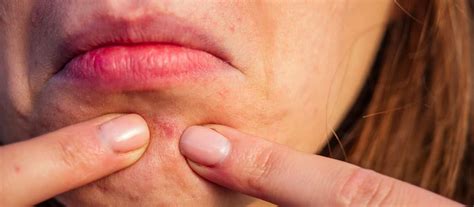 Menopausal Acne What Causes It And How You Can Treat It Gen M