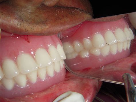 Treated Cases Implant Restore Dental Treatment Centre Rajkot