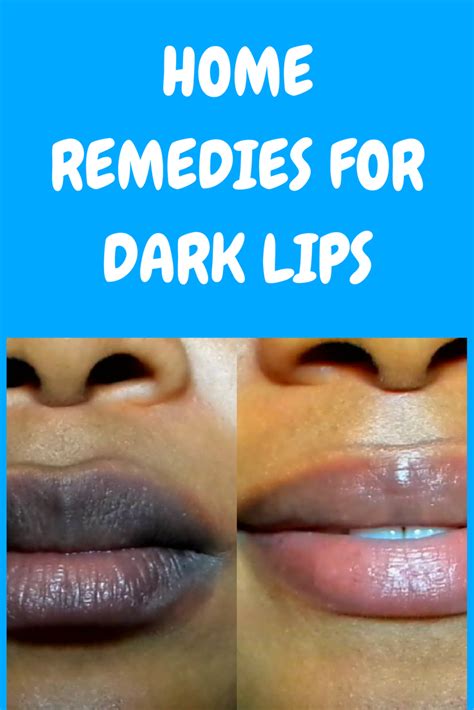 How To Get Rid Of Black Lips Home Remedies For Dark Lips Dark Lips