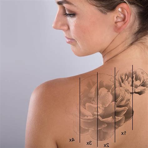 Chirurgiczne usuwanie tatuażu Medistica Chirurgia Estetyka