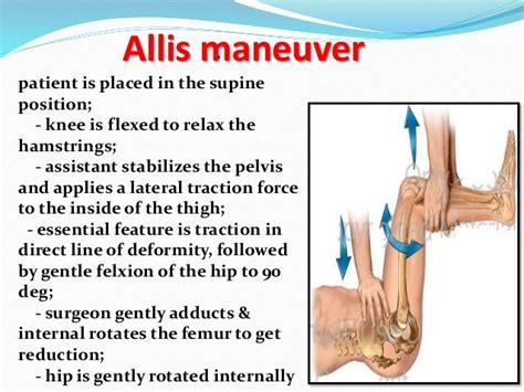 Allis Maneuver Hip Reduction