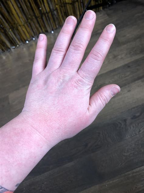 Anyone Else Ever Get A Rash On Their Hand Like The One Coming Up From