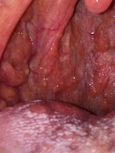 What Is This Yellow Spot On My Tonsillower Side Back Of Tonsil