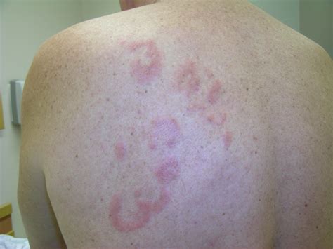 Lymphoma Skin Cancer Rash