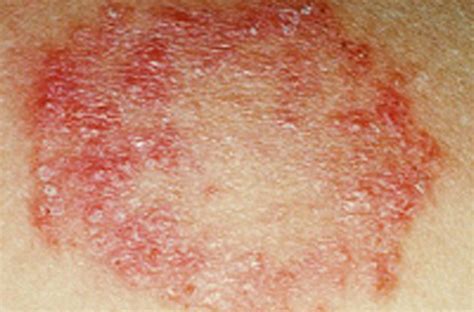 Fungal Rash On Skin Images