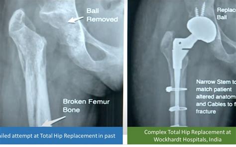 A Rare Fracture Femur Actebular Fracture Surgery And Hip Replacement