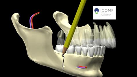 Estos dispositivos son los más eficaces para tratar los problemas obstructivos de la vía aérea superior. AVANCE MANDIBULAR OSTEOTOMIA SAGITAL - YouTube