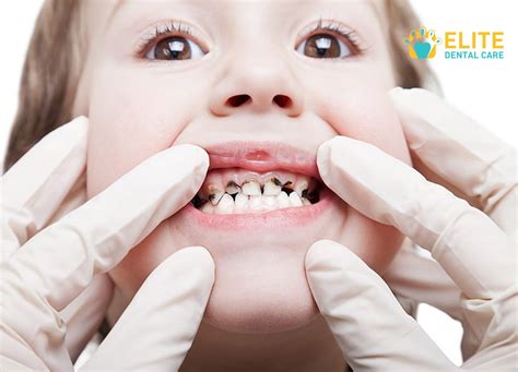 black teeth causes and treatment to handle the problem elite dental care tracy elite dental care