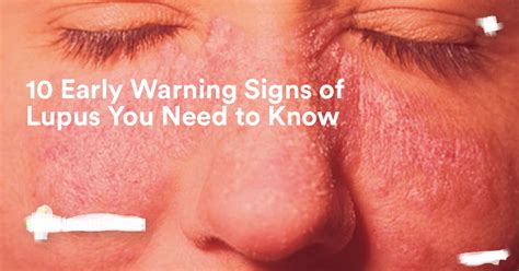 10 Early Warning Signs Of Lupus You Need To Know Health Queen