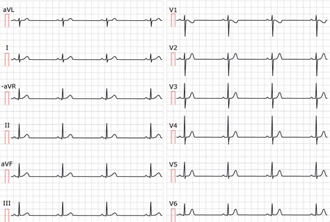 Sinus Bradycardia Definitions Ecg Causes And Management Ecg Learning
