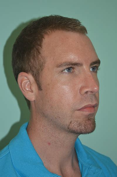 Male Rhinoplasty Davis Facial Plastic Surgery