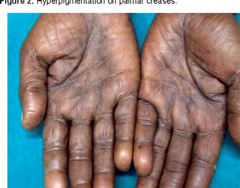 Figure 1 From An Unusual Case Of Capecitabine Hyperpigmentation Is