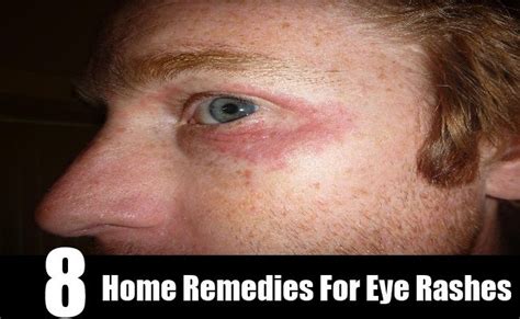 8 Home Remedies For Eye Rashes Home Remedies Severe Itching Remedies