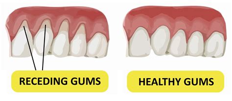 A thorough cleaning during your visit will go a long way in keeping the teeth and gums healthy. Everything you need to know about receding gums ...
