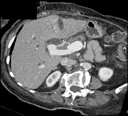portal vein thrombosis liver case studies ctisus ct scanning
