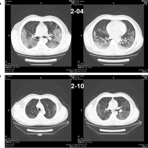 Chest Ct Of A Male Patient 47 Years Old A He Underwent A Chest Ct