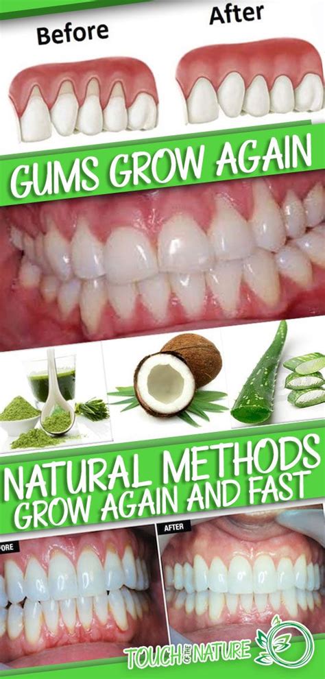 How To Get Healthy Gums At Home Unugtp News