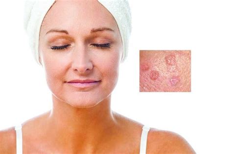Sebaceous Hyperplasia 2 Ultimate Symptoms And Causes