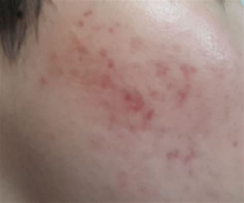 Red Acne Scars Natural Treatment