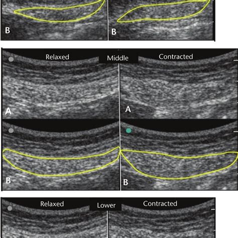 Ultrasound Images Of The Donor Right Side Left Panel And The Intact