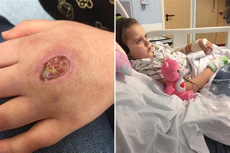 Terrified Schoolgirl 8 Left With Gaping Hole In Her Hand After She