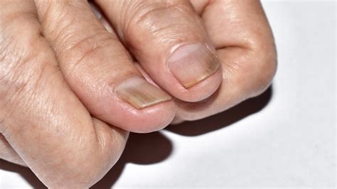 11 Signs Your Nails Can Give You About Your Health