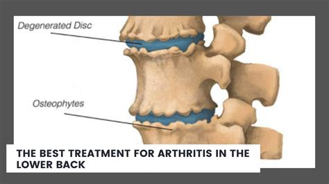 The Best Treatment For Arthritis In The Lower Back Solving Pain With