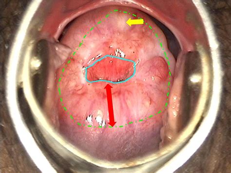 Atlas Of Visual Inspection Of The Cervix With Acetic Acid For Screening
