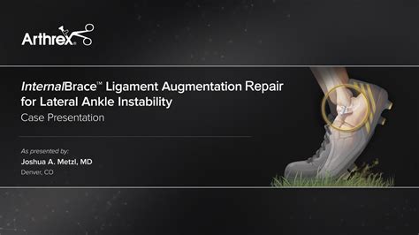 Arthrex Internalbrace Ligament Augmentation Procedure For Lateral