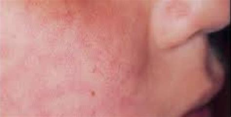 Hiv Skin Rash Images Causes Symptoms Treatment Hubpages