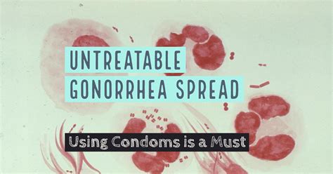 Oral Sex Spreading Antibiotic Resistant Gonorrhea — Using Condoms Is A Must Life4me
