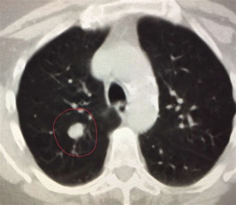 What Is The Significance Of A Spot On The Lung The Three Eyed