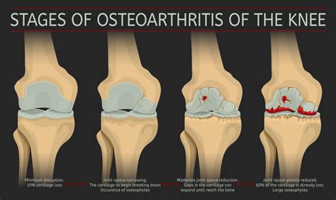 Progression And Possible Complications Of Osteoarthritis Oa Painscale