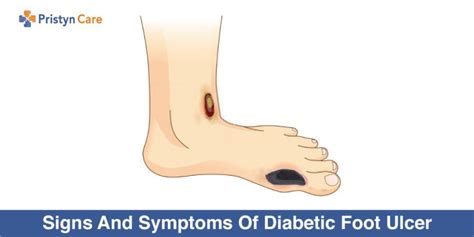 Complications Of Diabetic Foot Ulcer Pristyn Care