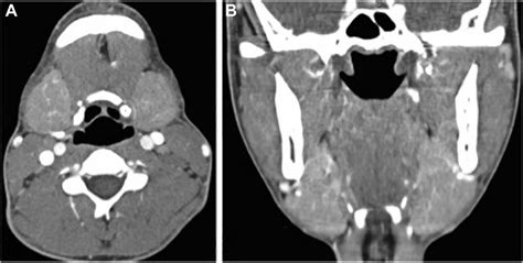 E Contrast Enhanced Neck Ct Axial A And Coronal B Images At The
