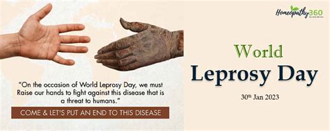 World Leprosy Day 30th January 2023 Homeopathy360