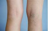 Photos of Early Varicose Veins Treatment