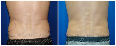 Love Handle Liposuction Houston Lipo Center