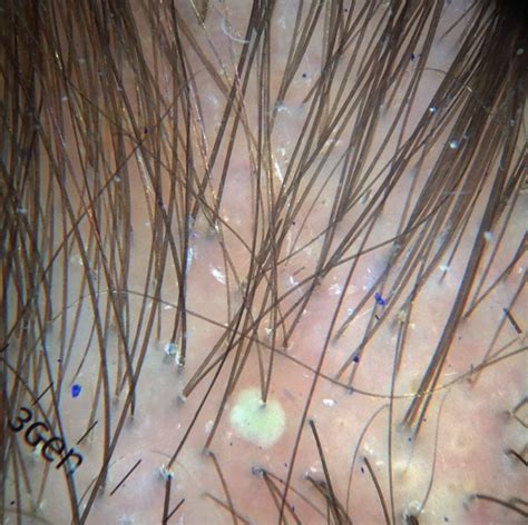 Scalp Folliculitis Not A Single Entity — Donovan Hair Clinic