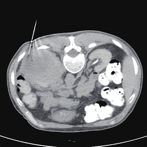 Ct Guided Intraoperative Puncture Biopsy Of The Space Occupying Lesion