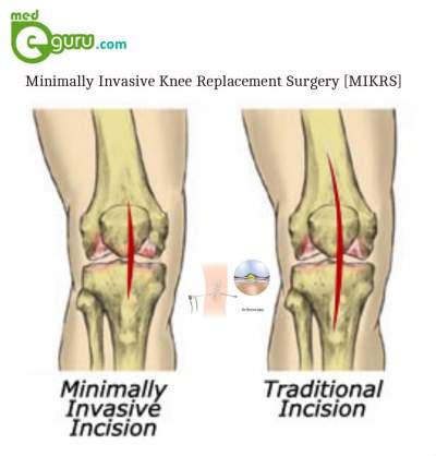 Minimally Invasive Knee Replacement Surgery Overviewmed E Guru