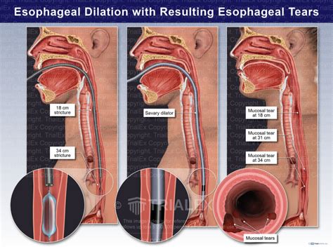 Savory Esophageal Dilators Hot Sex Picture