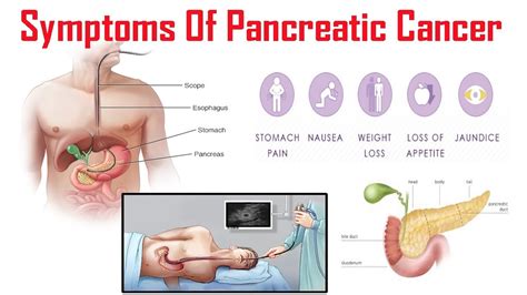 Learn about the signs and symptoms of pancreatic cancer, including, but not limited to: Pancreatic Cancer - Causes, Risk Factors, Symptoms, Prevention