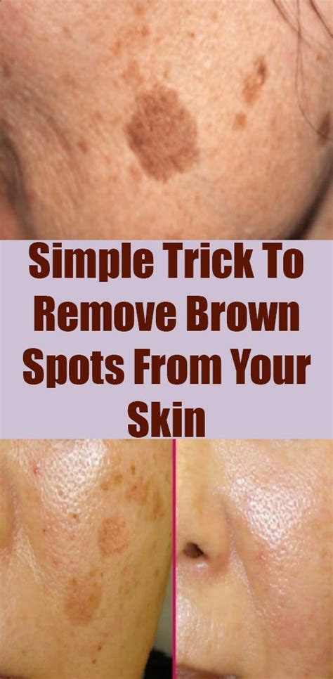 Simple Trick To Remove Brown Spots From Your Skin Brown Spots Simple