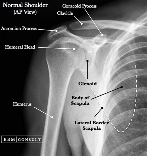 Anterior Shoulder Dislocation General Review