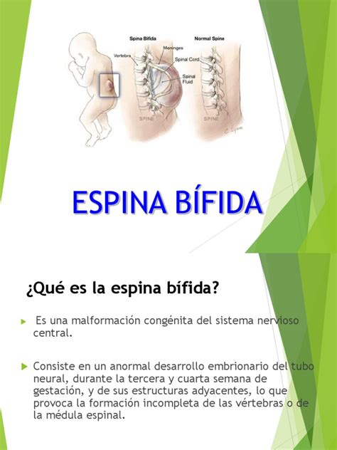Espina Bifida Presentacion2 Rtt Ciencias De La Salud