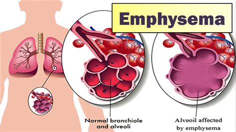 Imc Emphysema Symptoms And Causes