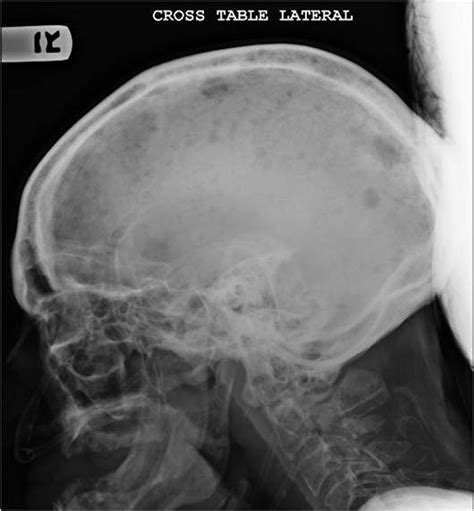 Multiple Myeloma With Mixed Lytic And Blastic Bone Lesions With