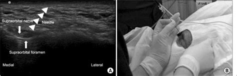 Figure 1 From Ultrasound Guided Pulsed Radiofrequency Treatment For