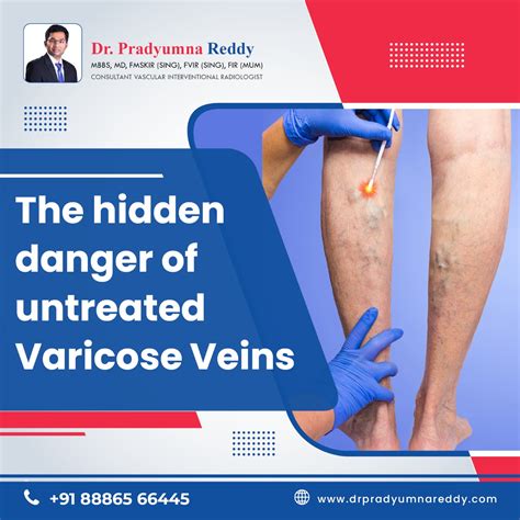 The Hidden Danger Of Untreated Varicose Veins